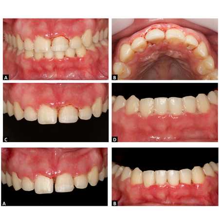 Non-surgical periodontal treatment for a patient with necrotizing gingivitis: