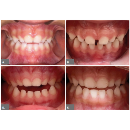 Decrease in anterior open bite after pacifier cessation in children with mouth breathing: case series