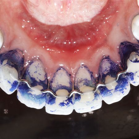 Índices periodontais de dois tipos de contenções 3 x 3: 0,032” aço V-Loop versus 0,0215” aço coaxial — um ensaio clínico cruzado randomizado
