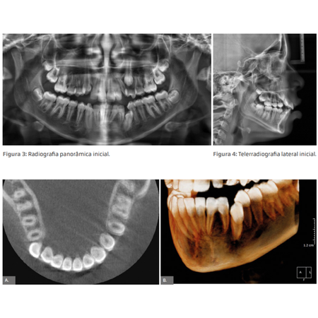 Orthodontic management of fused incisors associated with supernumerary teeth and canine impaction: a case report