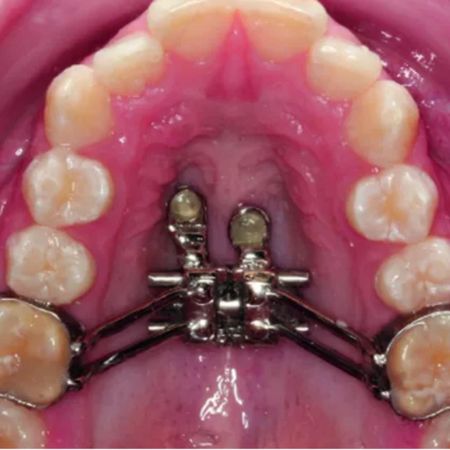 Short-term assessment of pain and discomfort during rapid maxillary expansion with tooth-bone-borne and tooth-borne appliances: randomized clinical trial