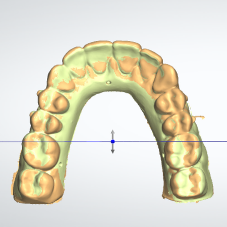 Dimensional stability of 3D-printed models for orthodontic aligners: a six-month storage evaluation