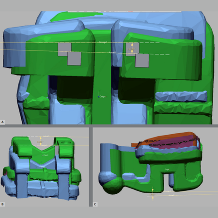 Comparação da precisão de duas técnicas para colagem indireta digital tridimensional de braquetes ortodônticos: um ensaio clínico randomizado