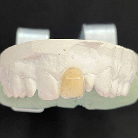 Soluções de limpeza para alinhadores ortodônticos: uma análise microbiológica e colorimétrica