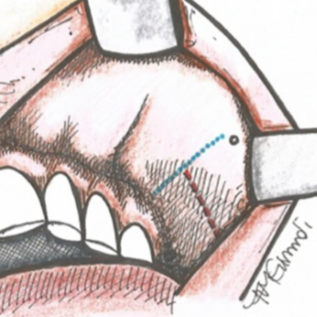 Buccal lipectomy: variations of the intraoral technique – integrative review
