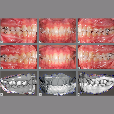 Selected clinical approaches for the treatment of classic Class II, division 1 malocclusion