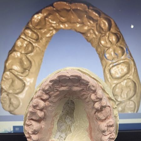 Reabilitação oral usando planejamento digital e CAD/CAM com blocos de resina composta