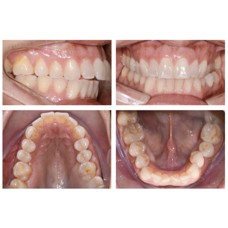 Corrección de la Clase II con apiñamiento y mordida cruzada posterior en un paciente adulto utilizando MARPE y alineadores de ortodoncia Invisalign