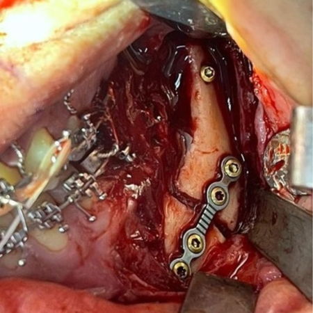 Proposed treatment protocol for tissue ischemia after maxillary segmentation: case report