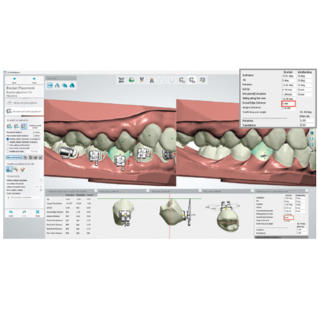 Does more cervical bonding influence torque expression in mandibular brackets?