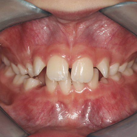 Improvement of facial harmony and correction of Class II malocclusion using functional orthopedic appliance and clear aligners: a case report