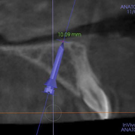 Tratamento da má oclusão de Classe III com ancoragem em mini-implantes em adultos jovens: resultados em curto prazo e longo prazo