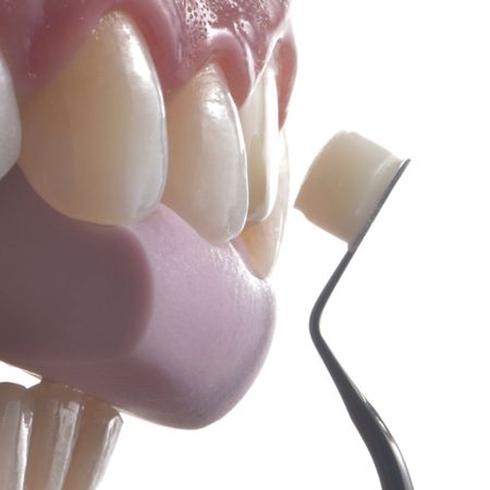 Incisivo central escurecido unitário: um dos maiores desafios na Odontologia Restauradora estética