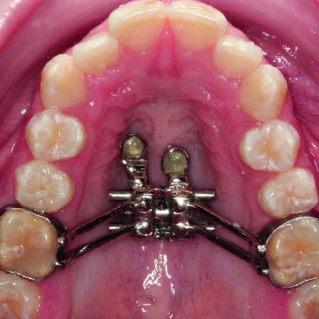 Avaliação em curto prazo da dor e desconforto durante a expansão rápida da maxila com aparelhos dento-osseossuportados e dentossuportados: ensaio clínico randomizado