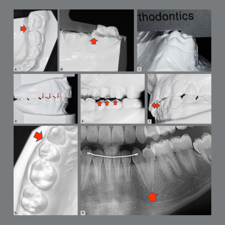 Orthodontic finishing errors detected in board-approved cases: common types and prediction