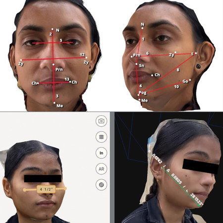 Avaliação comparativa entre a fotogrametria com câmera única e o escaneamento facial baseado em LIDAR