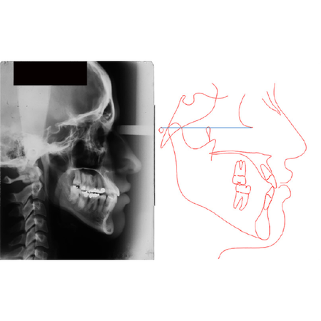 Atratividade do perfil facial em pacientes com má oclusão de Classe III tratados ortodonticamente: comparação entre protocolos com e sem extração