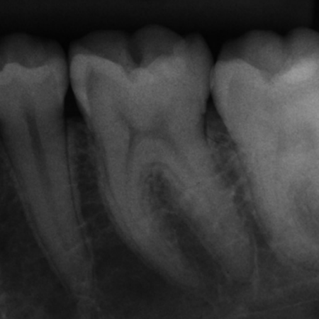 AMALGAM AND COMPOSITE RESIN ASSOCIATION IN DIRECT CLASS II RESTORATION: LONGEVITY AND AESTHETIC COMBINATION?