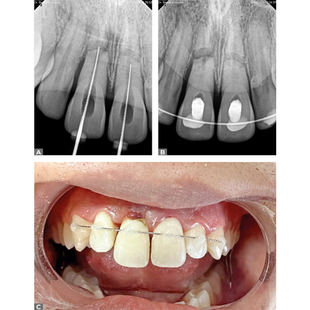 Manejo conservador de fraturas radiculares traumáticas em incisivos centrais superiores: relato de caso com dois anos de controle