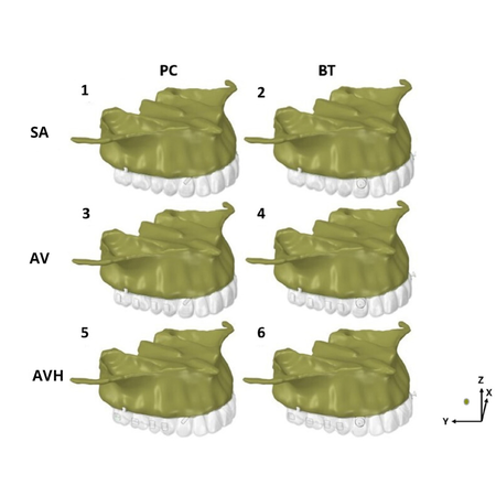 Effect of different attachment configurations and skeletal anchorage force application points on canines during distalization of maxillary second molars with clear aligners: a finite element study
