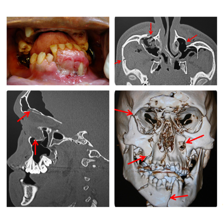 Panfacial fractures: case report